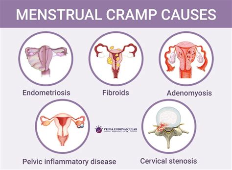 are severe menstrual cramps similar to contractions